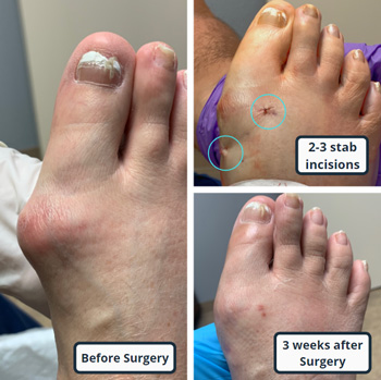 minimally invasive bunion surgery