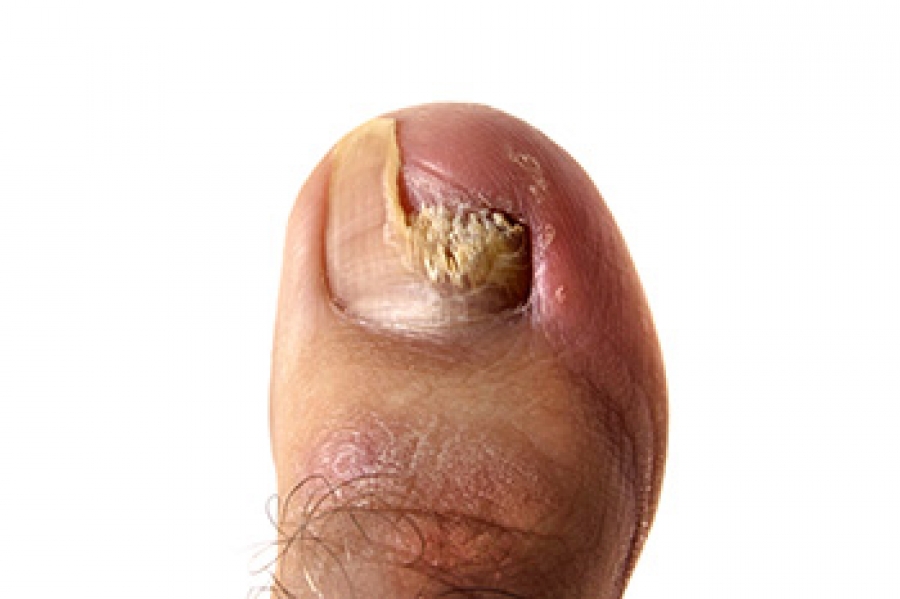 Aliver Liquid Anti Fungal Nail Treatment Finger Toe Care Foot Fungus  Remover Repair Medical Oil Anti Infection Antibacteria at Home |  Catch.com.au