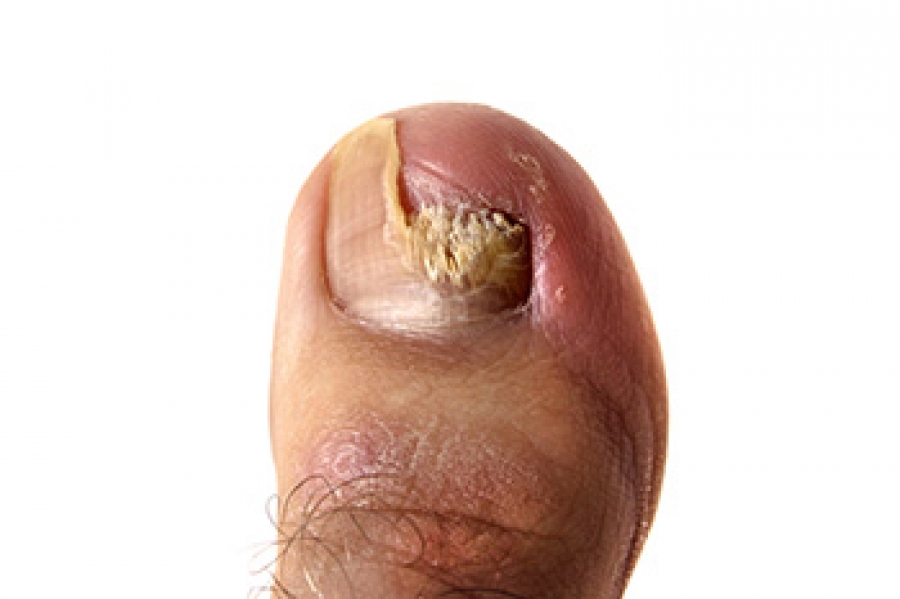 Thick Toenails: Diagnosis, Pictures, Causes, and Treatments