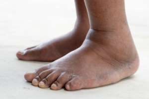 Possible Causes of Swollen Feet
