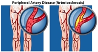 Causes and Diagnosis of Peripheral Artery Disease